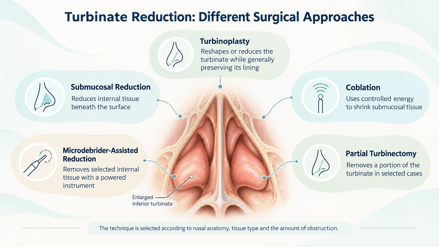Turbinoplasty — Turbinate Procedures Compared educational diagram