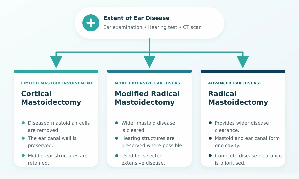 Cortical Mastoidectomy — Types of Mastoidectomy educational diagram