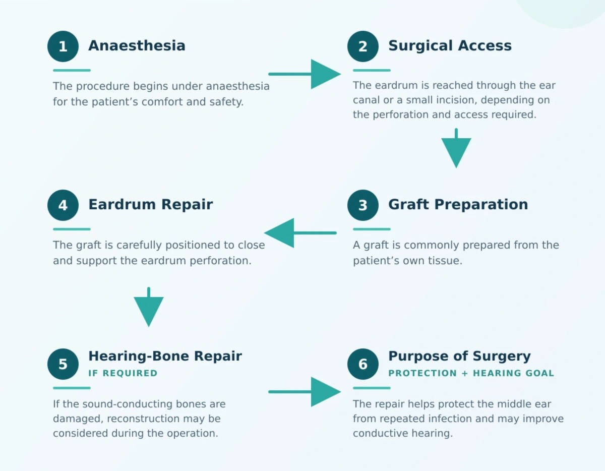 Tympanoplasty Surgery — What Happens During Tympanoplasty? educational diagram